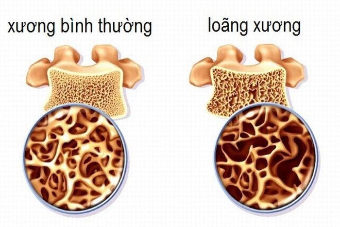 Ai cần kiểm tra mật độ xương