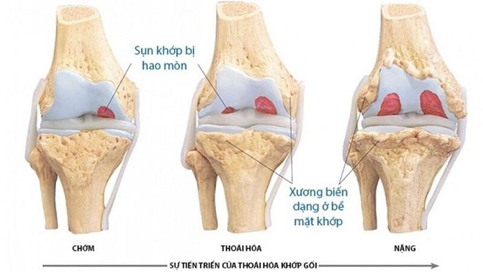 Sử dụng gậy đúng cách giúp giảm sự phát triển của bệnh thoái hoá khớp gối một cách đáng kể.