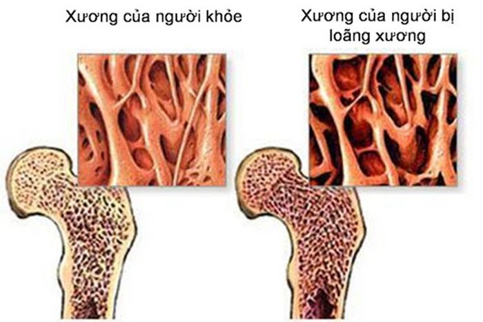 Đo mật độ xương để chẩn đoán bệnh loãng xương và nguy cơ gãy xương