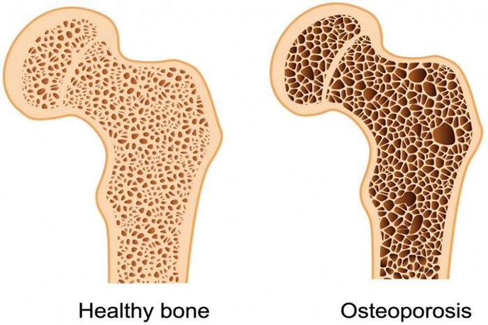 So sánh hình ảnh giữa xương khỏe mạnh và loãng xương