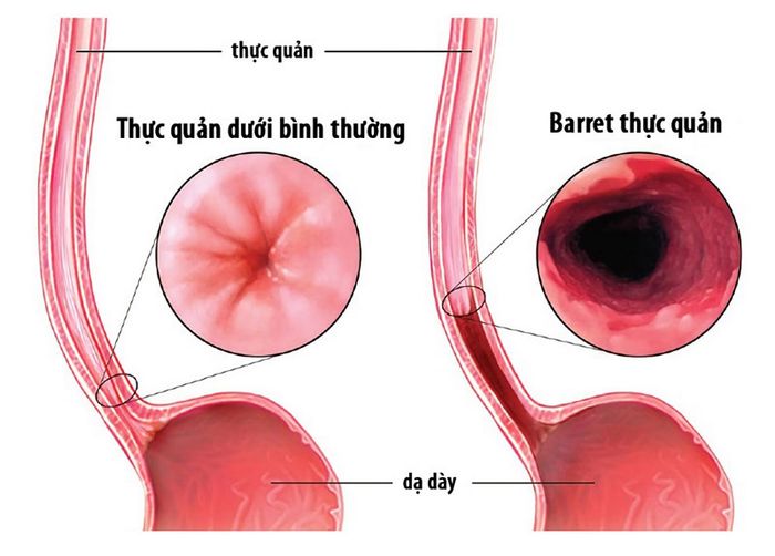 Barrett thực quản là một phản ứng thường gặp của bệnh trào ngược dạ dày