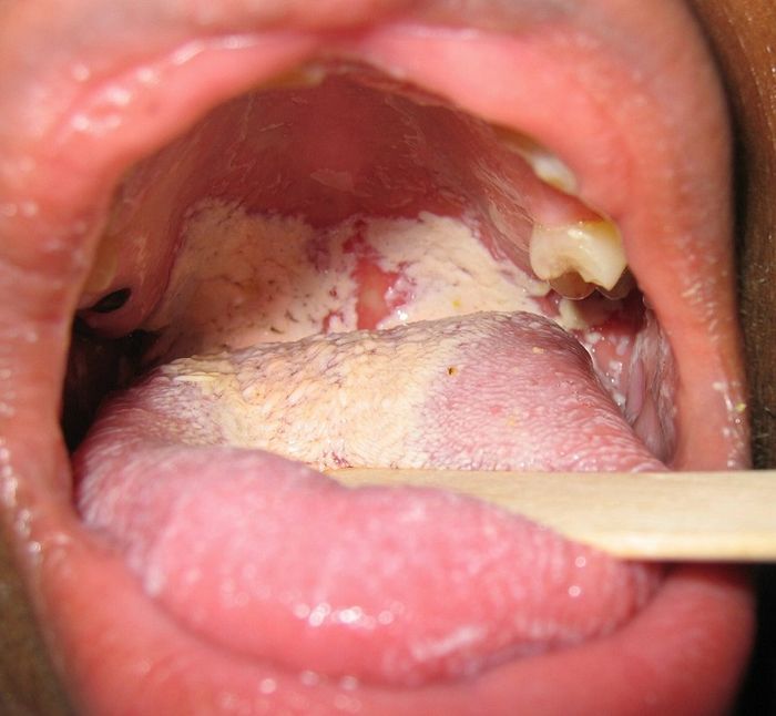 Nên cảnh giác với bệnh nấm miệng ở trẻ