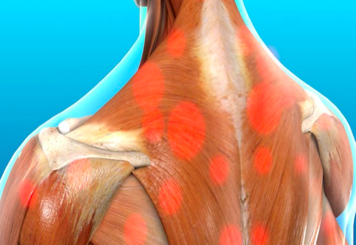 Mô phỏng các điểm Trigger Point trên các sợi cơ