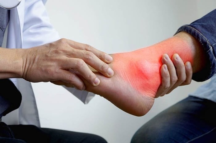 Bệnh Gout thường được gây ra chủ yếu bởi việc tiêu thụ quá nhiều thực phẩm giàu purin như hải sản và thịt đỏ.