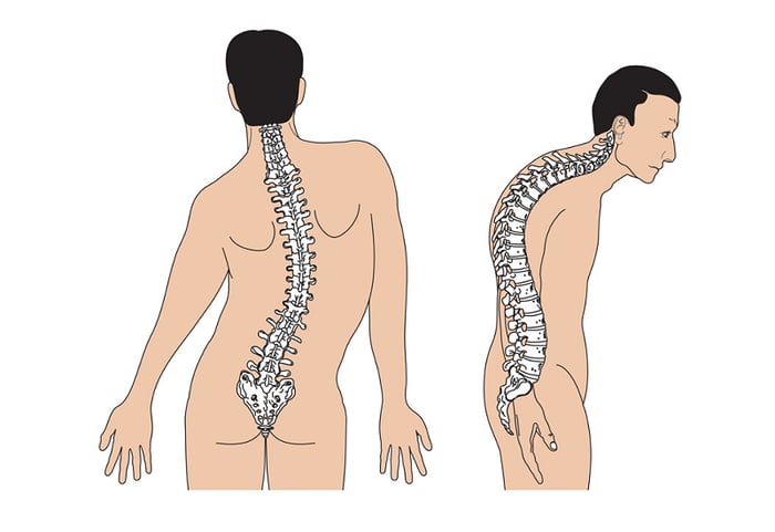 Xương cột sống bị vẹo hoặc gù có thể là biểu hiện của nhuyễn xương