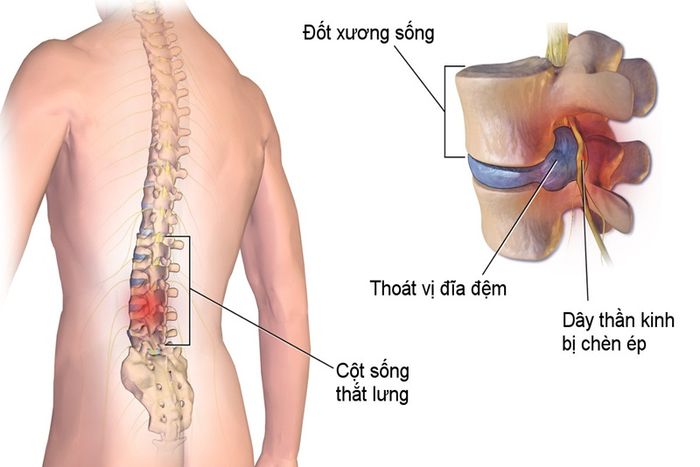 Những thắc mắc chung về tình trạng thoái hóa cột sống mà nhiều người đọc gặp phải