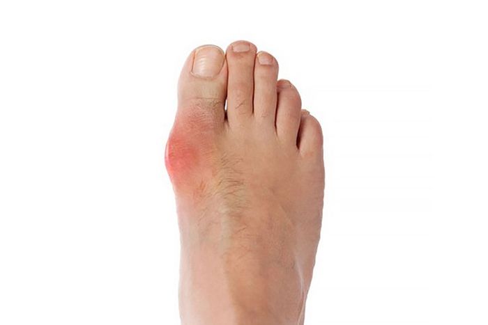 Bệnh gout gây viêm và sưng tấy ở các khớp