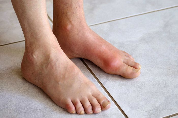 Dấu hiệu ban đầu của bệnh gout