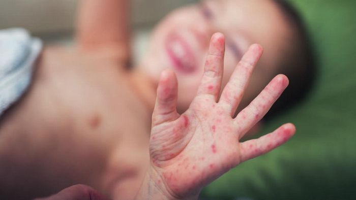 The disease can cause rash on hands, feet or cause red ulcers in the mouth