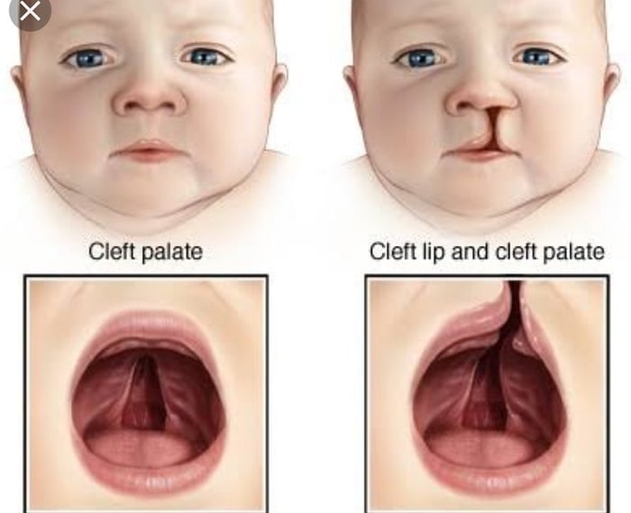 Dạng biến dị thường gặp ở trẻ mắc hội chứng DiGeorge