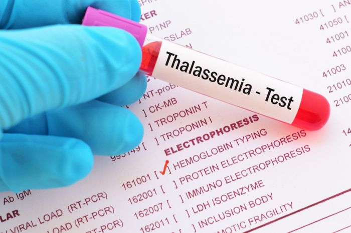 Phát hiện sớm bệnh Thalassemia ở thai nhi và trẻ nhỏ giúp điều trị bệnh hiệu quả hơn