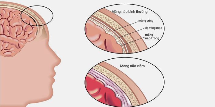 Hình ảnh so sánh giữa màng não bình thường và màng não bị viêm