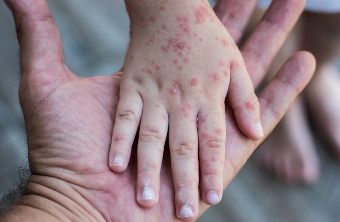 Rubella bẩm sinh xảy ra khi thai nhi được nhiễm virus từ mẹ trong quá trình thai kỳ