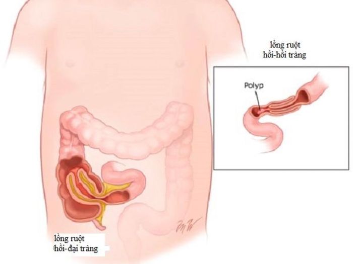 Sự xuất hiện của khối u, polyp trong ruột làm thay đổi hoạt động của ruột