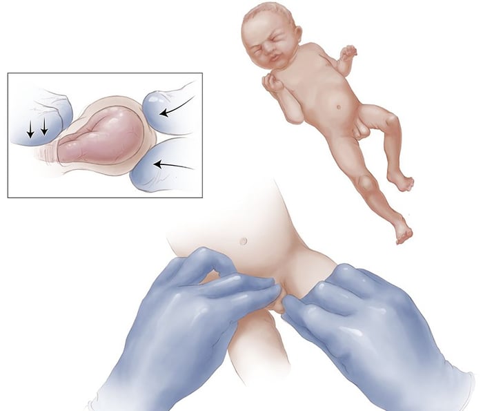 Thoát vị bẹn là một vấn đề phổ biến trong trẻ sinh non