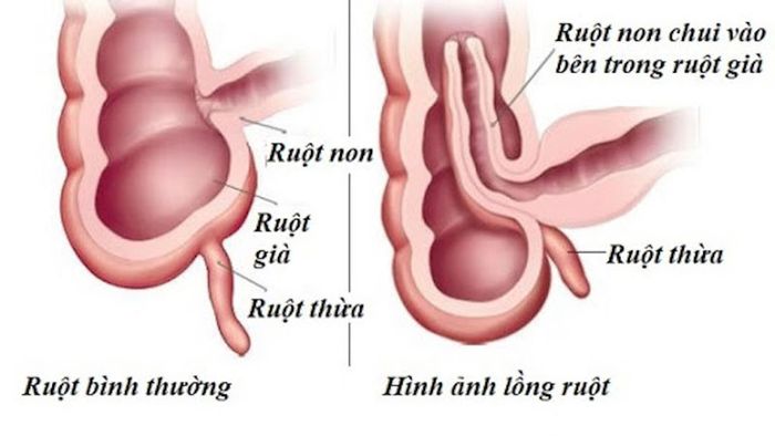 Nguyên nhân của bệnh lồng ruột