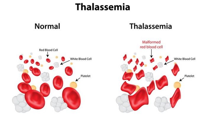 Bệnh Thalassemia là một loại bệnh liên quan đến biến đổi gen