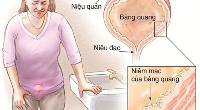 Các bệnh lý về bàng quang, đường tiết niệu có thể gây ra tiểu đêm thường xuyên