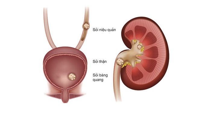 Tán sỏi niệu quản - kỹ thuật tiên tiến xử lý sỏi tiết niệu