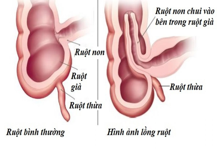 Trẻ bị đi ngoài ra máu do lồng ruột cấp tính