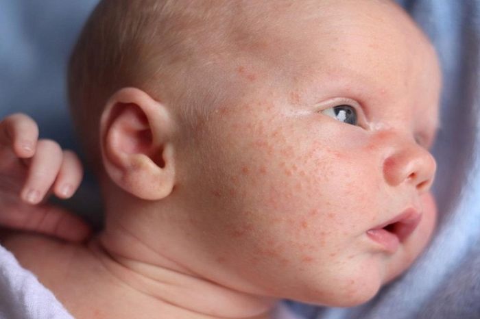 Dị ứng phấn rôm làm trẻ khó chịu, quấy khóc vào ban đêm