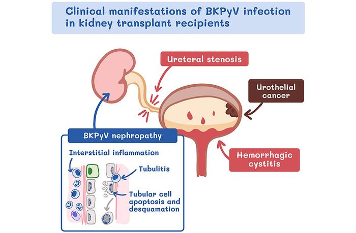 Biến chứng của bệnh thận do virus BKV có nguy hiểm không là điều mà nhiều người quan tâm