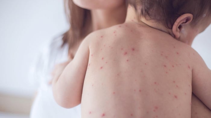 Rubella so với bệnh sởi có điểm khác biệt gì?