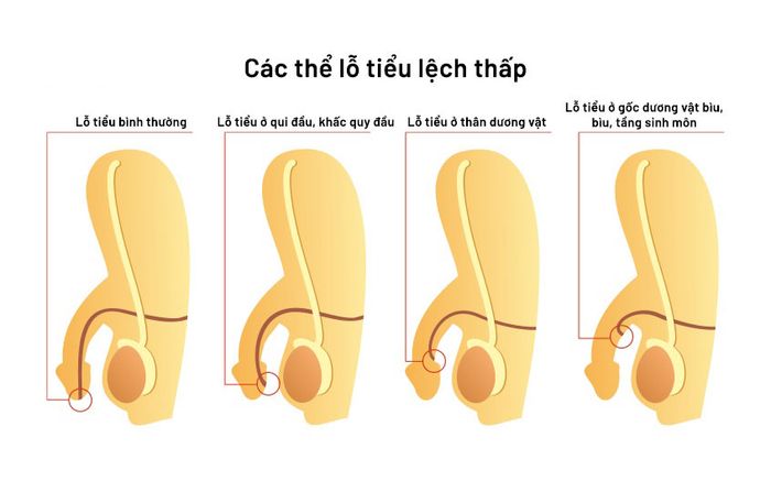 Dị tật lỗ tiểu đóng thấp thường gặp ở các bé trai