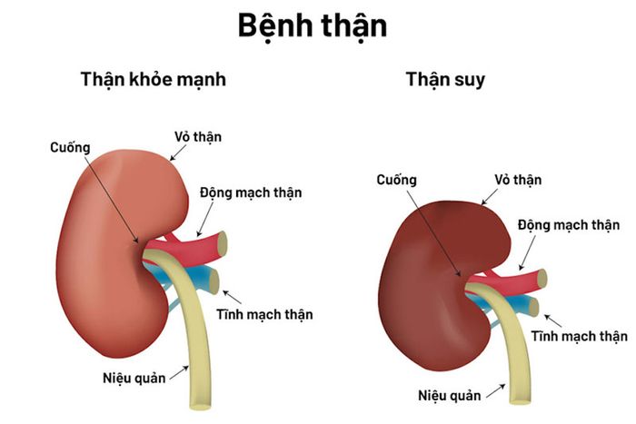 Suy thận là tình trạng suy giảm chức năng của thận