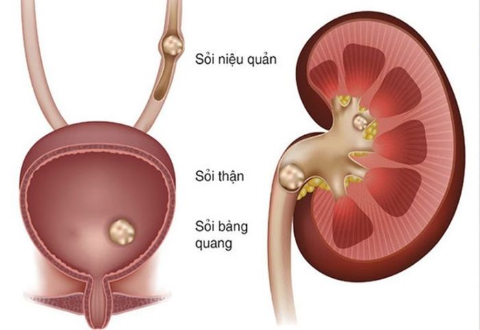 Sỏi niệu quản là một bệnh phổ biến