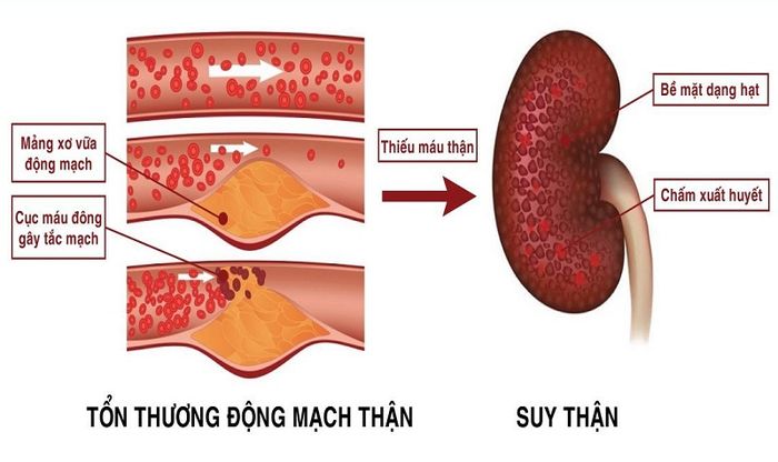 Các vấn đề về thận thường gây ra triệu chứng nước tiểu có váng