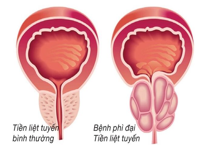 Phì đại của tuyến tiền liệt có thể gây ra tình trạng bí tiểu