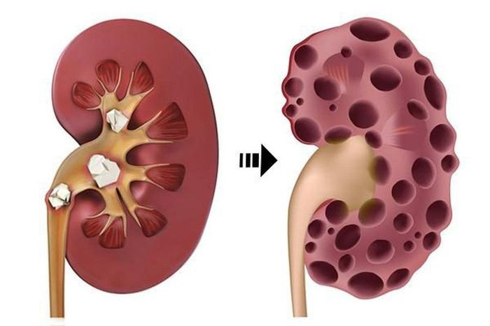 Suy thận là một bệnh nguy hiểm, có thể gây ra các biến chứng nặng nếu không được can thiệp kịp thời.