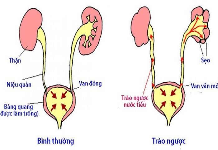 Biểu đồ minh họa tình trạng trào ngược niệu quản của bàng quang