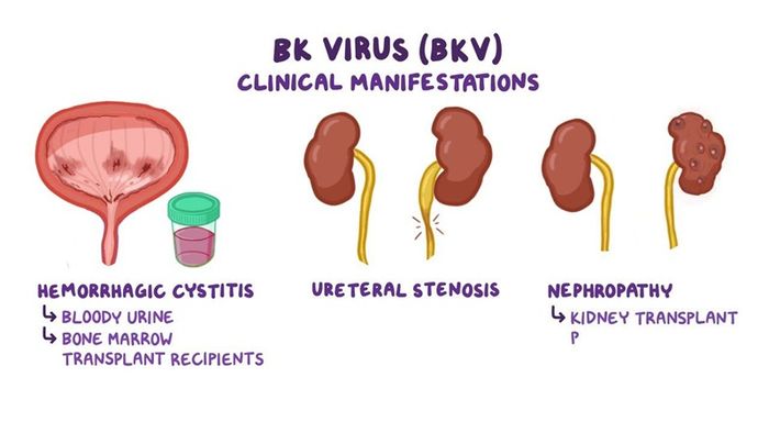 Khi mắc bệnh, bạn có thể gặp tình trạng tắc niệu quản và tiểu tiện.