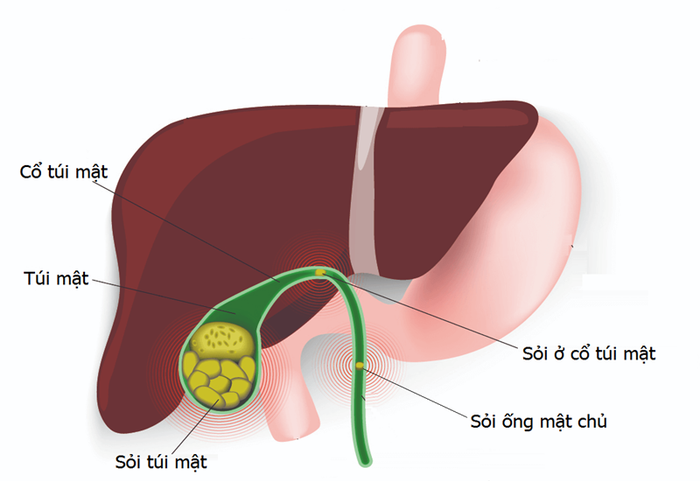 Sự tắc nghẽn dịch mật sẽ dẫn đến sỏi mật