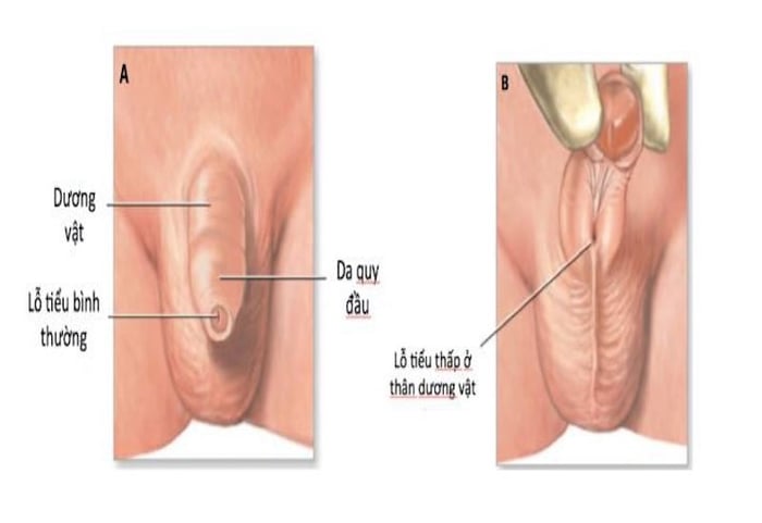 Mô phỏng tình trạng lỗ tiểu thấp ở bé trai