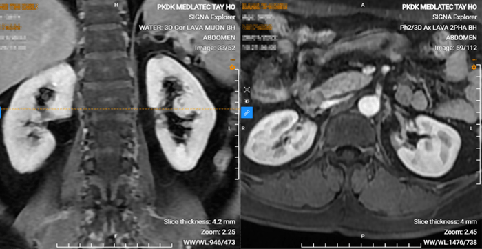 Hình MRI với việc tiêm chất tương phản cho thấy khối ngấm chất tương phản trong vỏ thận. Ảnh MRI cũng hiển thị sự phì đại của trụ Bertin của bệnh nhân.