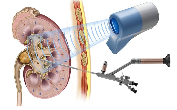 Phẫu thuật nội soi loại bỏ sỏi thận đang được áp dụng phổ biến