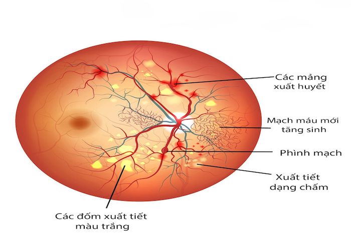 Biến chứng mạch máu do đái tháo đường