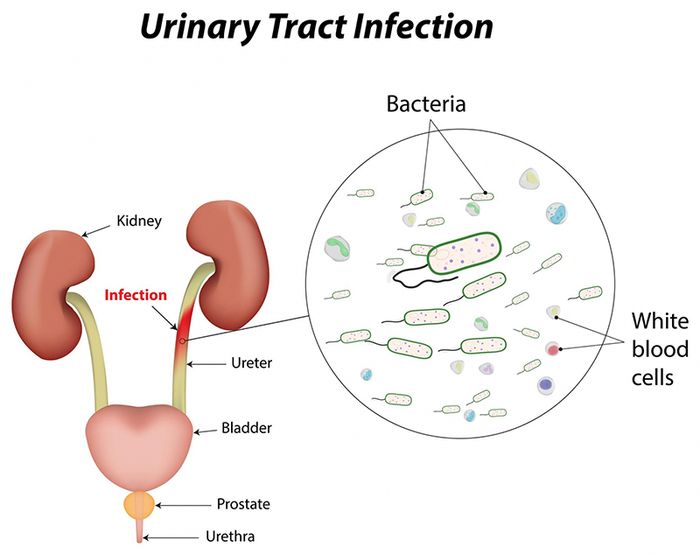 Nước tiểu sẫm màu là một trong những dấu hiệu nhận biết viêm đường tiết niệu