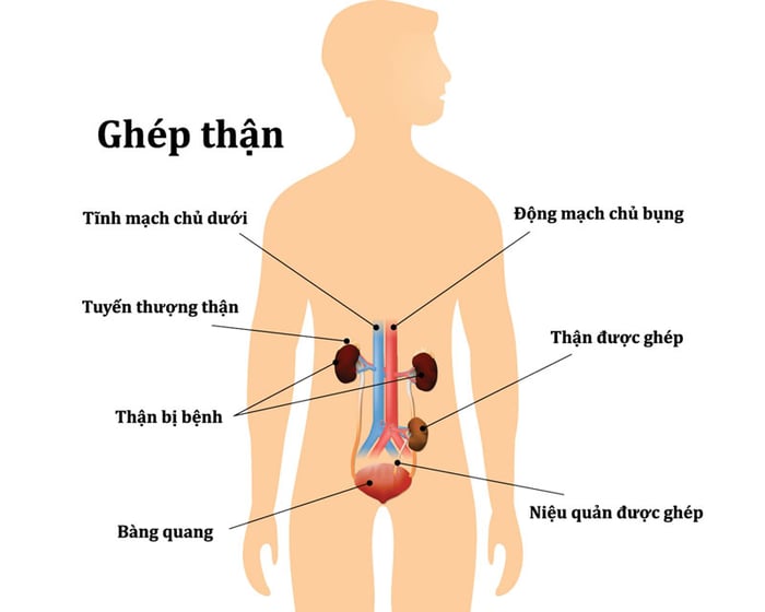 Ghép thận là phương pháp phẫu thuật để khôi phục chức năng thận bằng cách chuyển thận từ một người khác vào cơ thể.