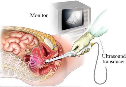 Siêu âm đầu dò tại MEDLATEC đảm bảo an toàn, nhanh chóng và chính xác