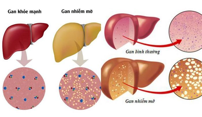 Bệnh gan nhiễm mỡ ban đầu có thể không gây nguy hiểm, nhưng nếu bệnh được phát triển đến giai đoạn cuối sẽ ảnh hưởng nghiêm trọng đến sức khỏe và tính mạng