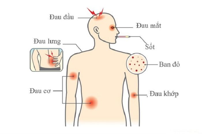 Triệu chứng của giai đoạn sốt trong Sốt xuất huyết