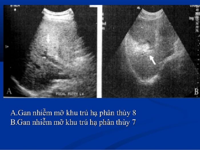 Mô tả gan béo trên siêu âm thường thấy gan có ánh sáng