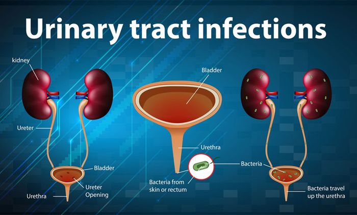 Nhiễm trùng đường tiểu thường được gây ra bởi vi khuẩn E.coli có nguồn gốc từ đường ruột.