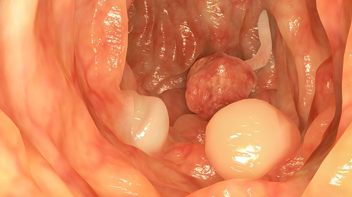 Dấu vết của polyp trong hậu môn