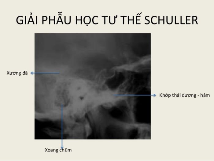 Chụp X - quang Hirtz được sử dụng để chẩn đoán viêm xoang.