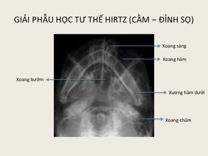 Chụp X - quang Hirtz dùng để chẩn đoán viêm xoang.